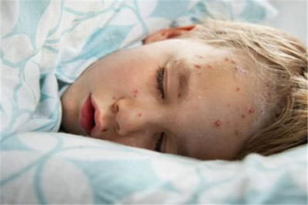 幼儿园孩子长水痘，得知后，妈妈不慌不忙做了这一件事