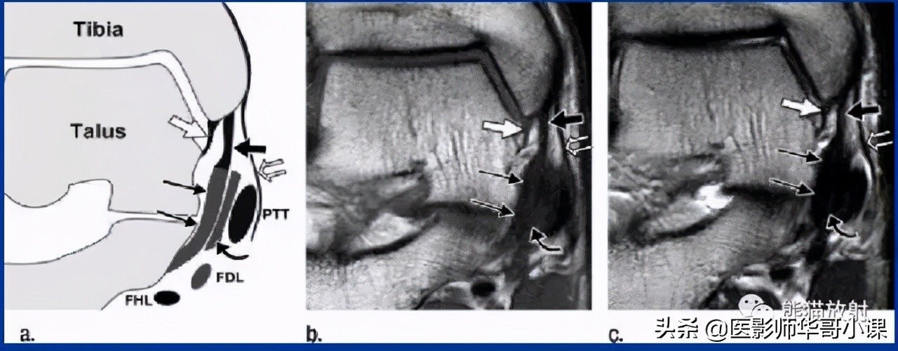 踝关节解剖视频课,解剖学韧带分布图