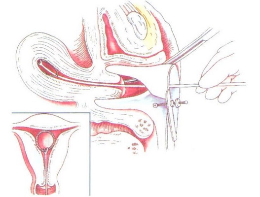 宫内节育器和节育环有什么区别,宫内节育器避孕环