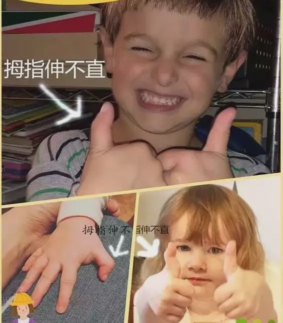 小儿狭窄性腱鞘炎应该怎么办？