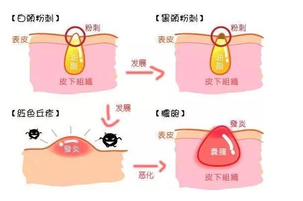 闭合性痘痘和闭合性粉刺是怎样的,闭合性粉刺怎么可以有效的去除