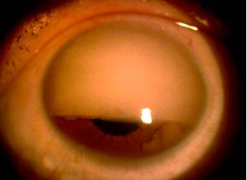 王方教授：严重硅油乳化眼手术处理一例