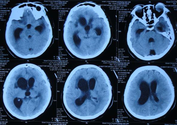 结核性脑积水,脑膜炎脑积水要治疗多久