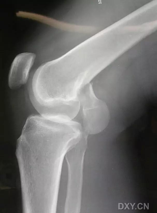 几种严重骨折医学名称,常见的骨折有哪些名称