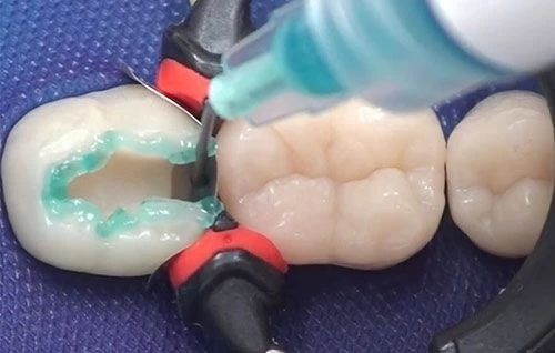 补牙后哪些事情你必须知道,补牙是不是必须要先杀神经