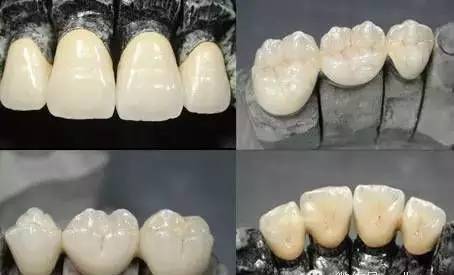 烤瓷牙的危害与副作用,全烤瓷牙有什么风险和后遗症