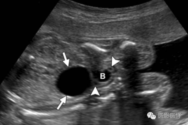 孕早期卵巢囊肿边界清形态规则,孕期卵巢囊肿呈液性伴点状回声