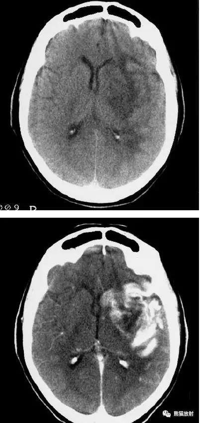 脑梗死丨演变、血供区域分布、CT表现