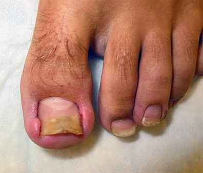 什么原因导致脚趾甲老是嵌甲,脚趾甲老是长到肉里怎么治疗啊