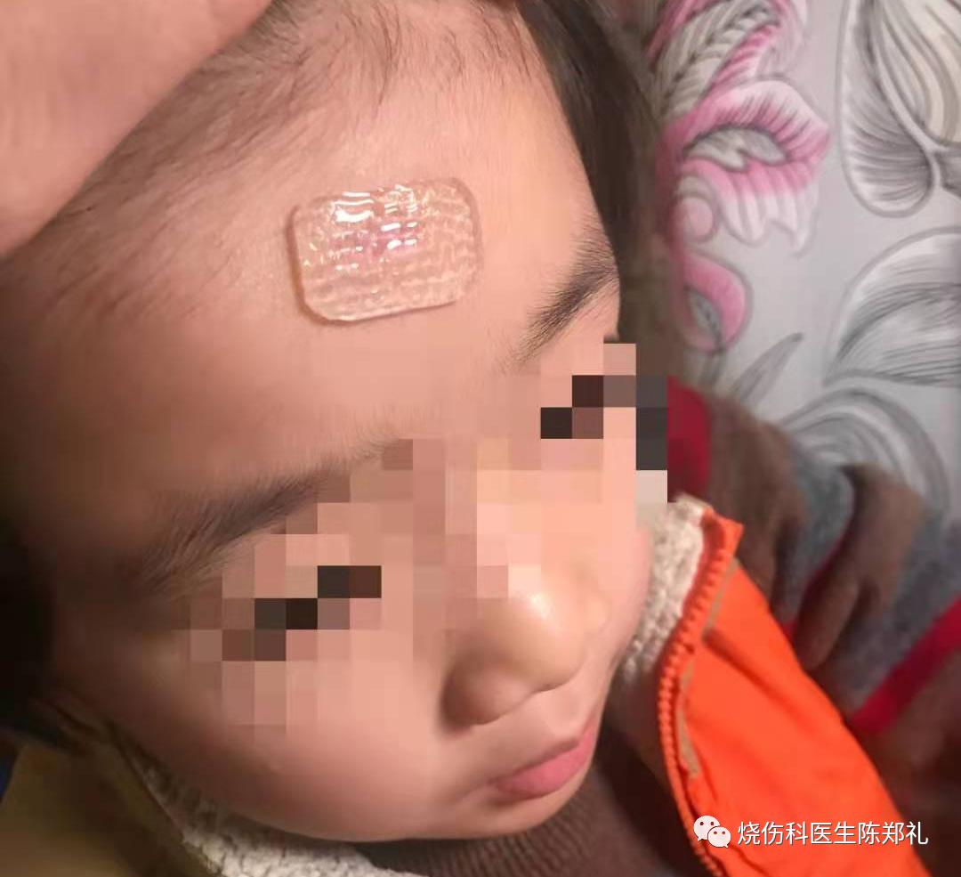 疤痕疙瘩怎么治疗最好最快,疤痕疙瘩中药治疗成功案例