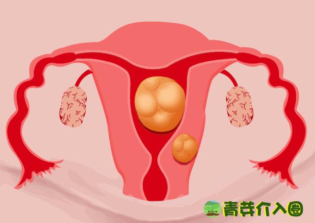 子宫肌瘤介入术动画,子宫肌瘤介入治疗动画演示