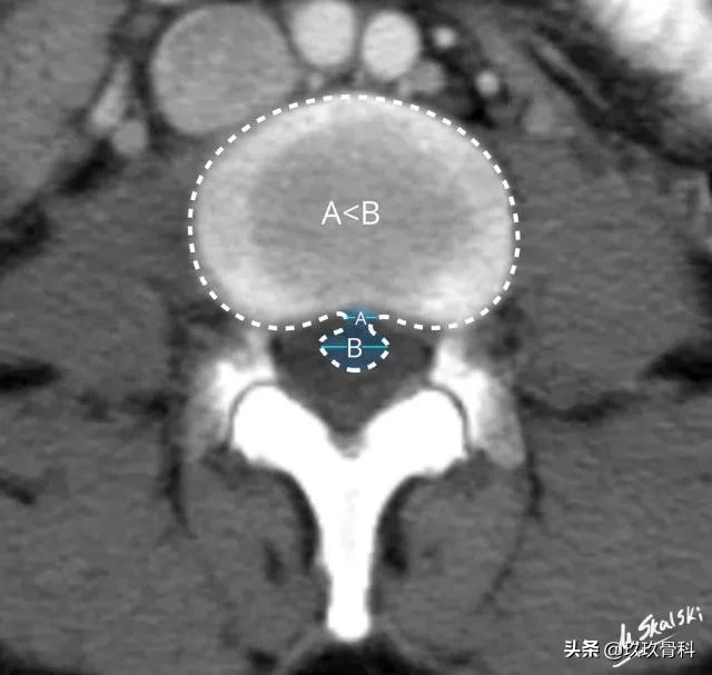 图解腰椎间盘突出,椎间盘髓核膨出图