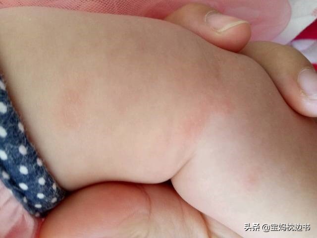 为什么我家宝宝湿疹越来越严重了,宝宝湿疹误区