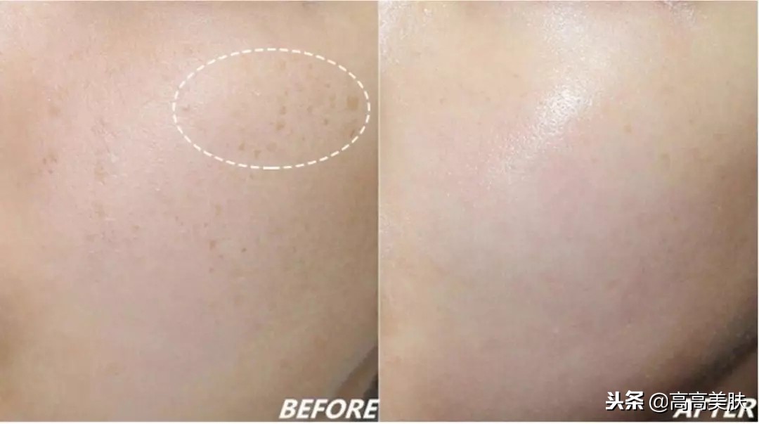 韩国东星制药美白祛斑霜,东星琅丝曲酸小黑瓶祛斑霜