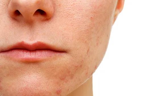 辟谣、吃酱油加深痘印?芦荟胶治好痘坑?别傻了!