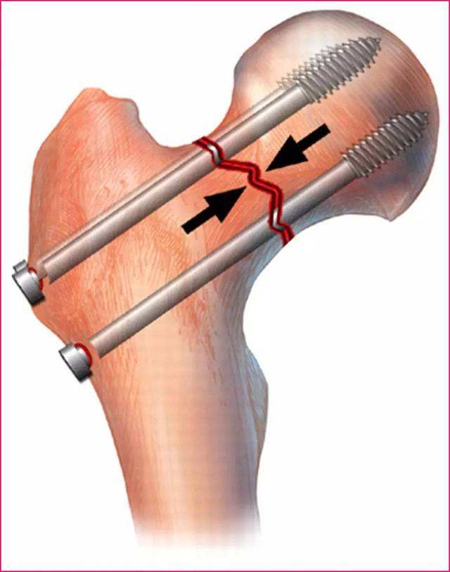 真实有效治疗骨折的方法,这几种骨折一定要注意
