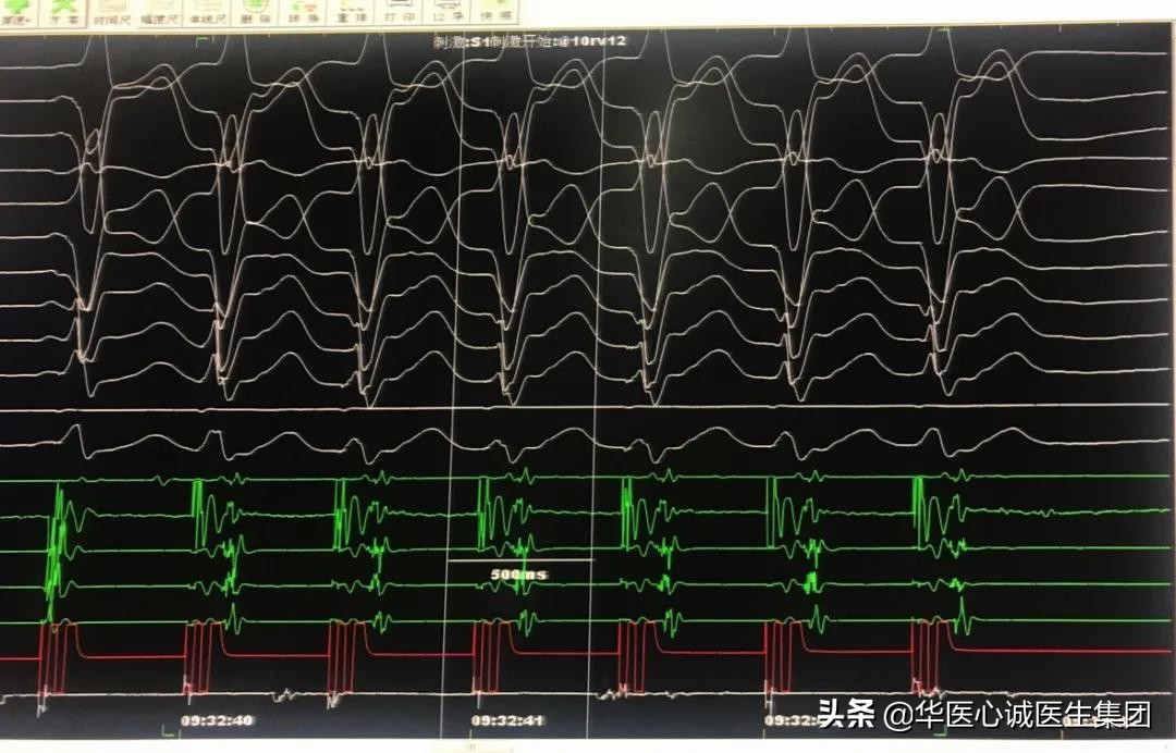 窦性心动过速查房,攀钢集团总医院心内科