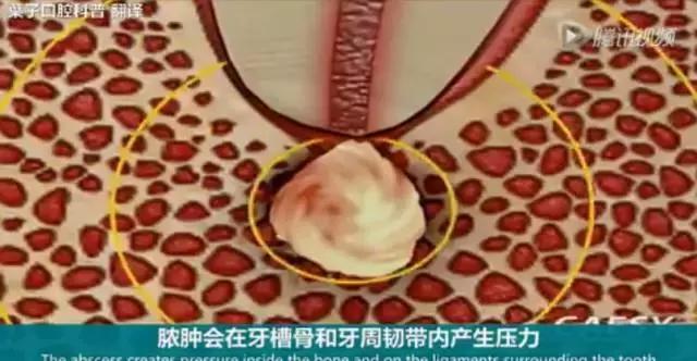 牙龈反复鼓包流脓是牙齿坏了吗,一上火牙龈就鼓包