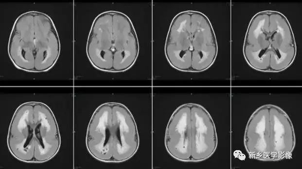 什么引起成人脑室扩大,哪些病可以导致左侧脑室增宽