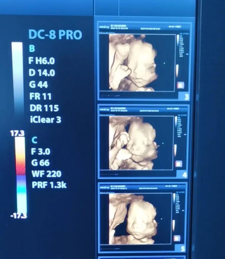 说说我第二次剖腹产的经历吧,剖宫产生娃是种什么样的体验