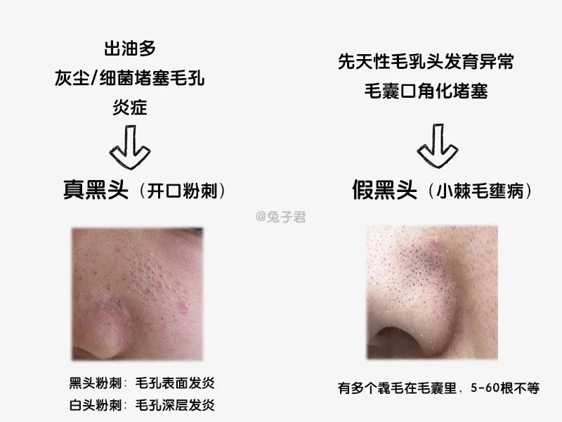 黑头反复的长还用清理吗,黑头反复长脸上老出油