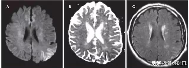 脑卒中病历诊断书图片,脑卒中影像判断技巧图解电子版