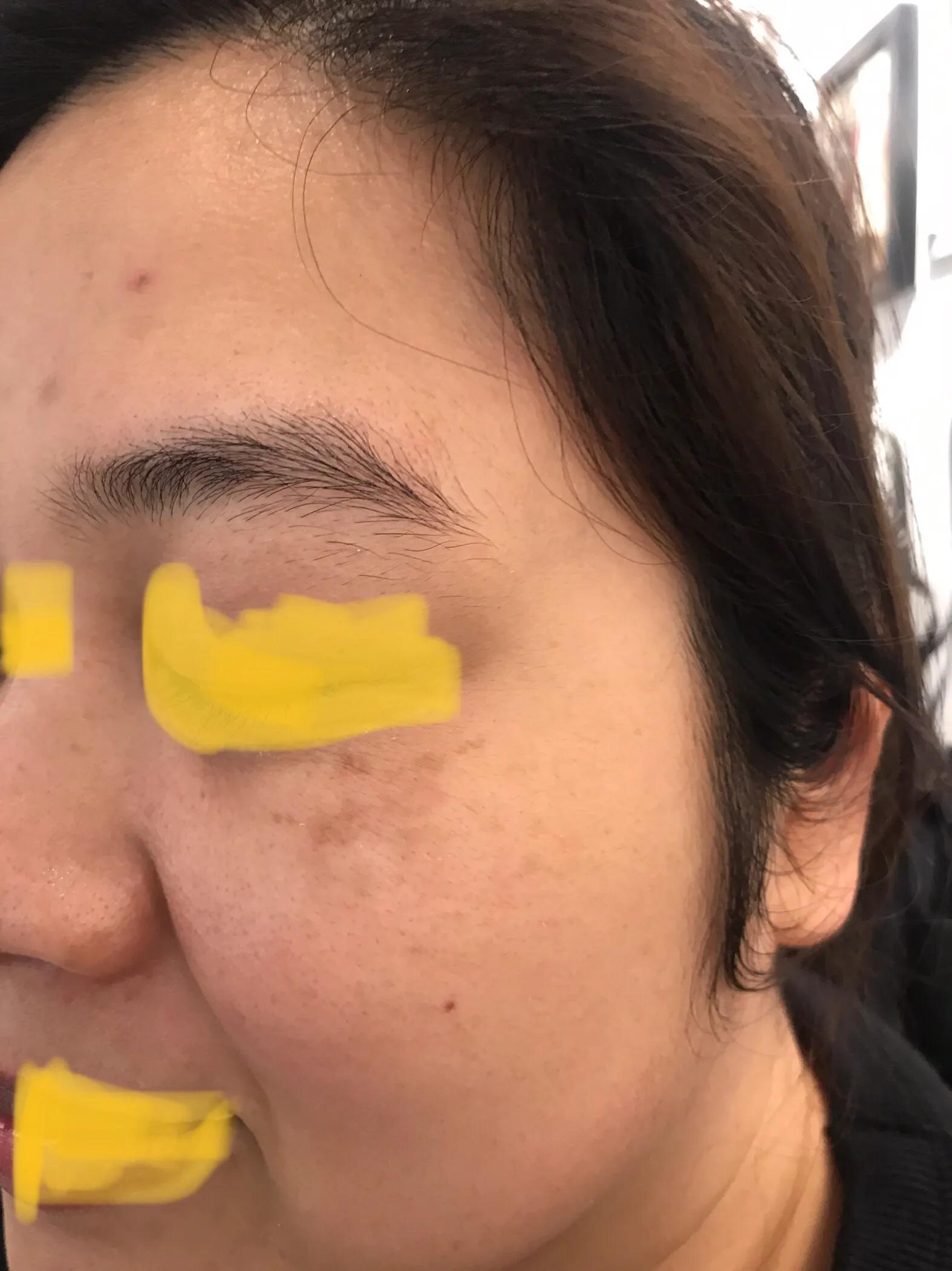 激光祛除斑点后留下的黑印,两次祛斑中间最好隔多久