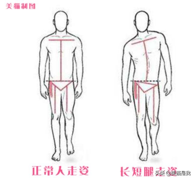 长短腿跟腿型能矫正吗,长短腿矫正锻炼方法左腿长右腿短
