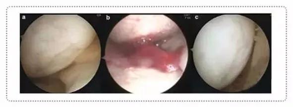 干细胞治疗膝关节软骨缺损,干细胞注射膝关节可以修复软骨吗