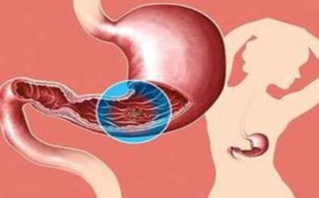 十二指肠球部溃疡是西医还是中医,十二指肠球部溃疡缓解腹痛的方法