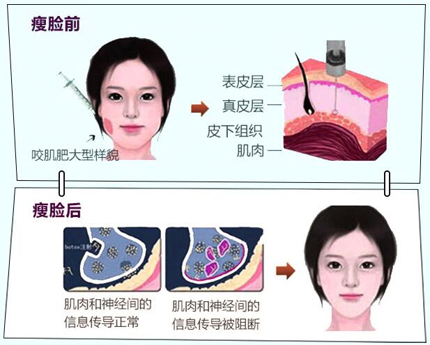打完瘦脸针几天可以敷面膜,瘦脸针打完后几天出效果