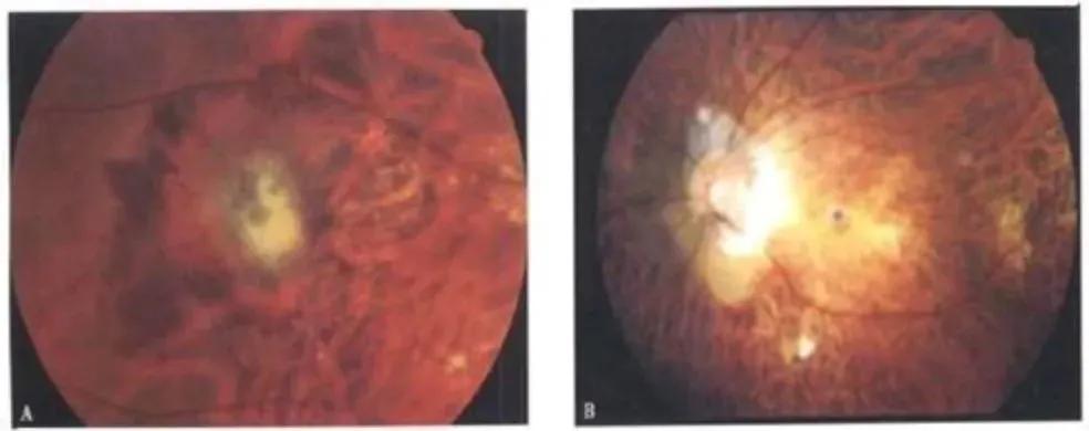 巩膜加固为什么能防止视网膜脱落,后巩膜加固术近视度数降低
