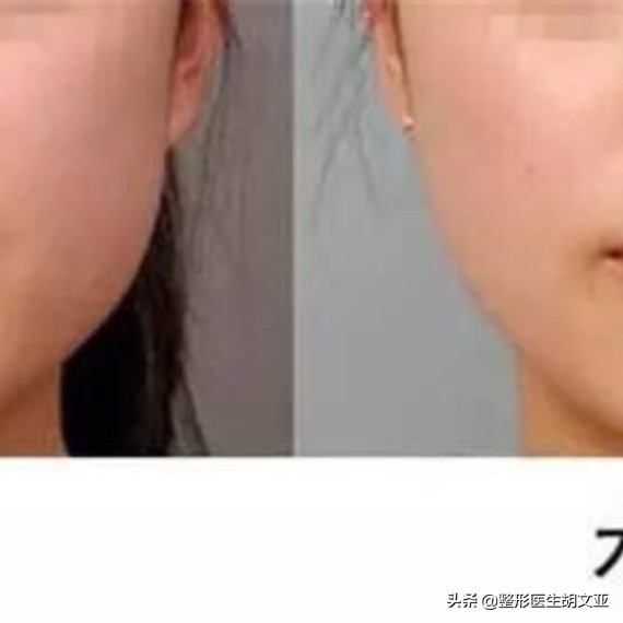 瘦脸针注意事项和禁忌,打瘦脸针前要吃饭