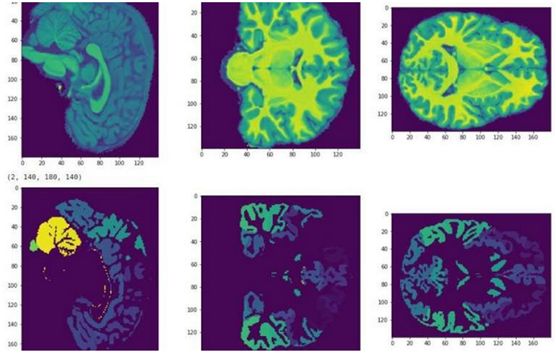 mri检查儿童身高,儿童智力可以通过脑部mri查出来吗