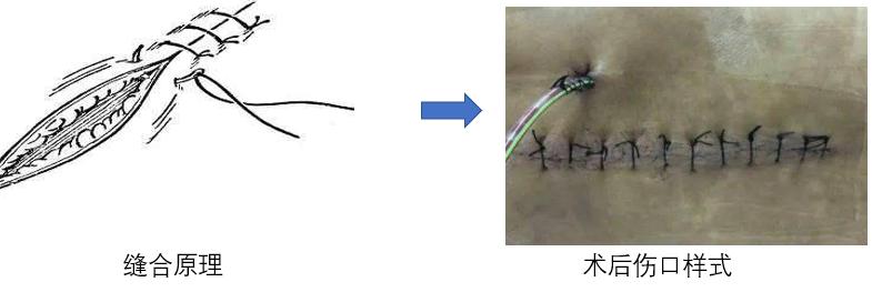 肺结节手术后需要拆线吗,腰椎手术后几天拆线最好