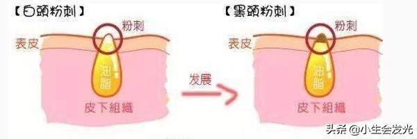 闭合性闭口怎么形成的,闭口怎么成痘痘了