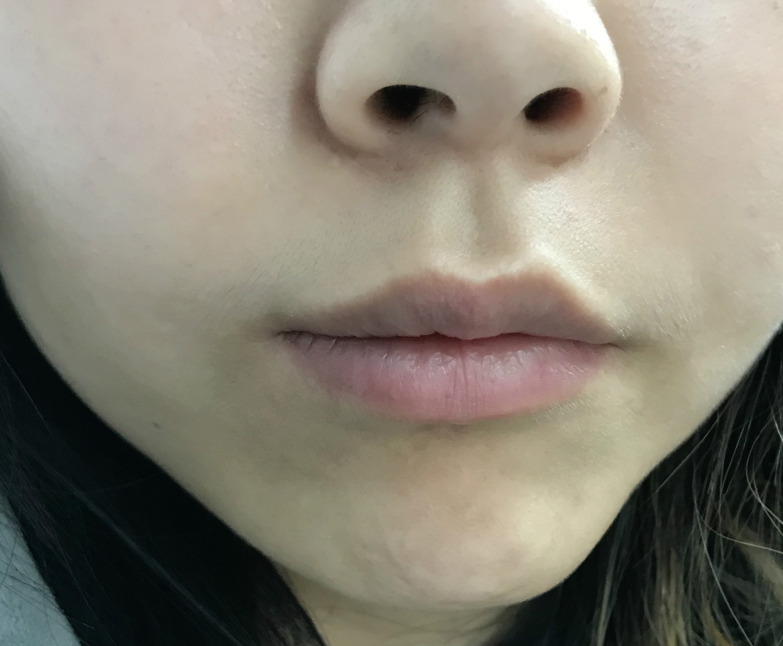 医美收毛孔价格表,医美收毛孔效果