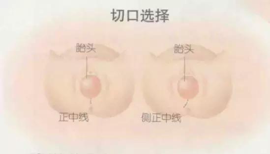 生孩子被侧切伤口会裂开吗,顺产侧切要挨一刀吗