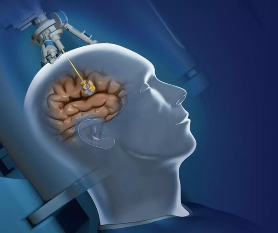 全球手术机器人排名,十大手术机器人