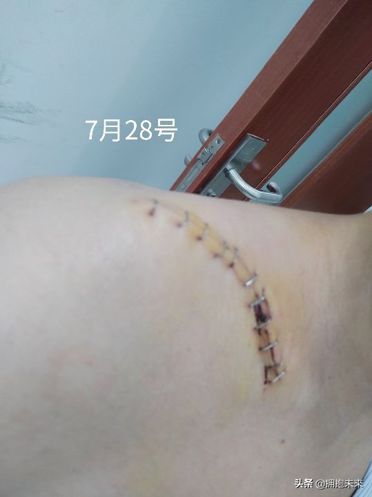 肾移植伤口可以自己换药吗,锁骨骨折取钢板后几天换药一次