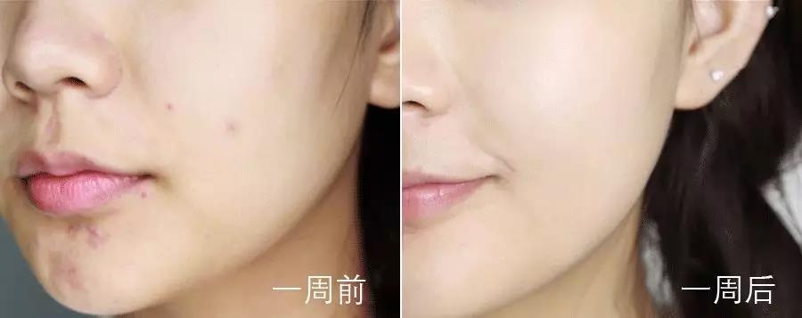 最好用最快祛痘的一款祛痘产品,老爸评测祛痘产品推荐