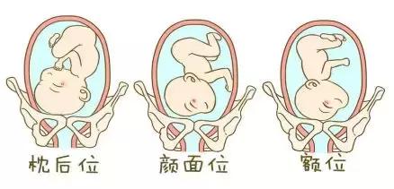 胎位不正可能导致难产？别紧张！了解这些，没你想得那么可怕
