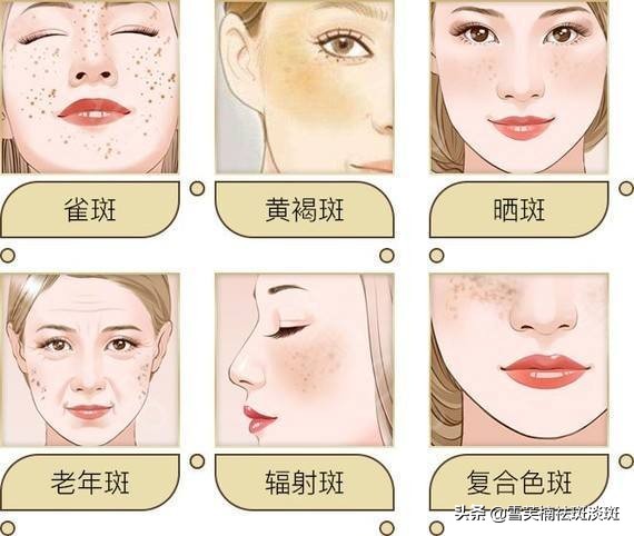 去斑点的最好方法淡斑精华,去斑点的最好方法淡斑