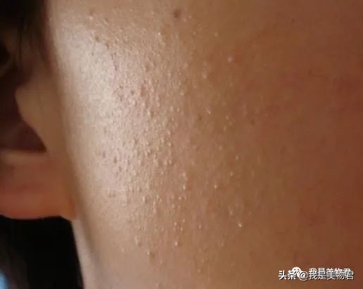 敏感肌最好的祛闭口神器,去闭口的最佳方法敏感肌