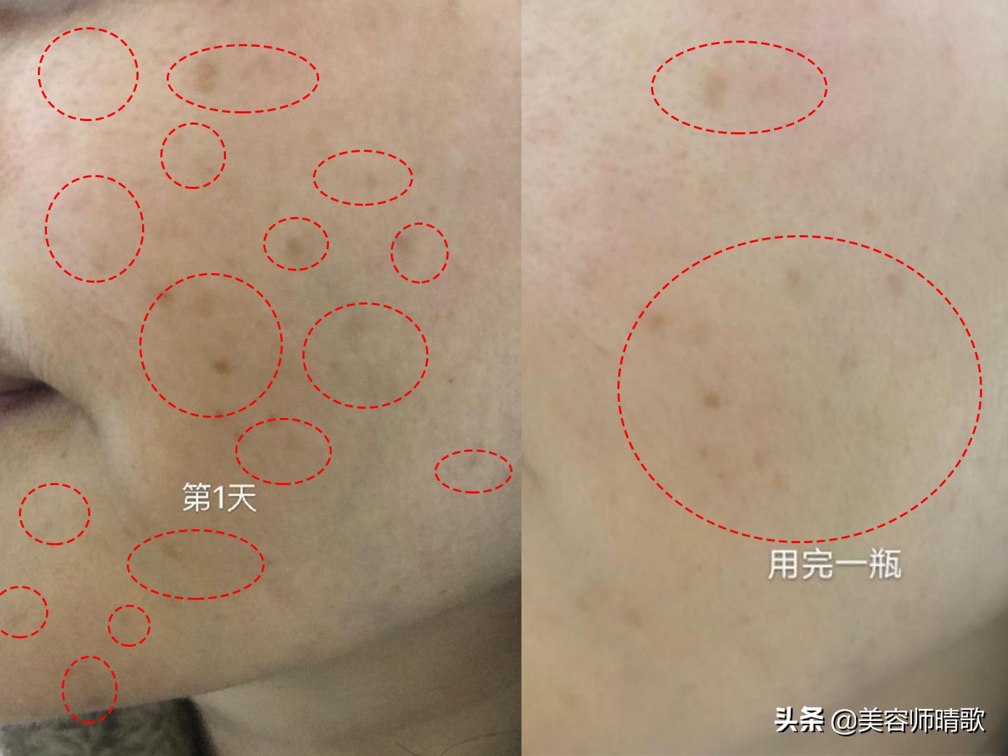 淡斑小白瓶精华100ml,小白瓶淡斑精华适合40岁的用吗