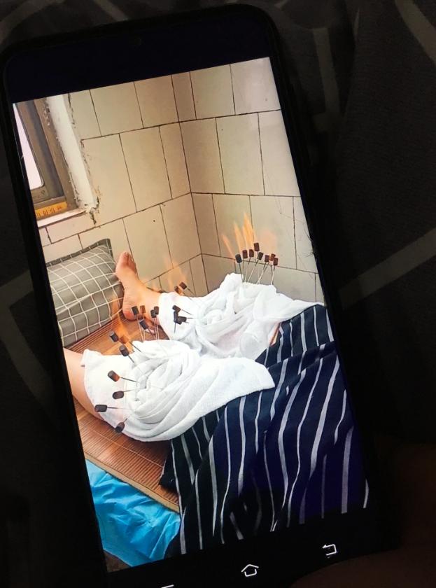 河南杞县115人针灸后针眼溃烂：针灸前被注射药物，事发后仍有人苦求继续针灸，患者需手术切开伤口排脓