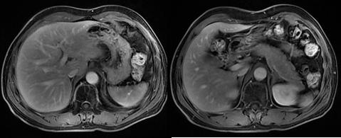 放疗局控百分百：鼻咽癌肝转移化疗联合免疫治疗失败后