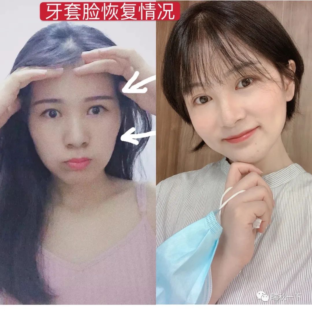 牙齿矫正，你后悔了吗？