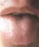 老中医舌苔从厚变薄了,任博士老中医讲舌苔