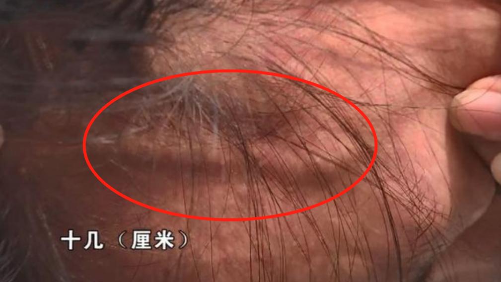 花19.9元在美容院按脸后，一根血管爆出来了？店长：美容师辞职了